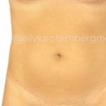 Liposuction 360 Before & After Patient #3478