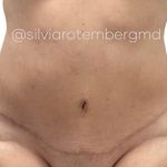Tummy Tuck Before & After Patient #3479