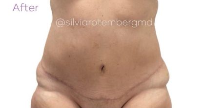 Tummy Tuck Before & After Patient #3479