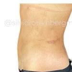 Liposuction 360 Before & After Patient #3478