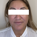 XERF Radiofrequency Skin Tightening Before & After Patient #3862