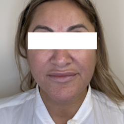 XERF Radiofrequency Skin Tightening Before & After Patient #3862