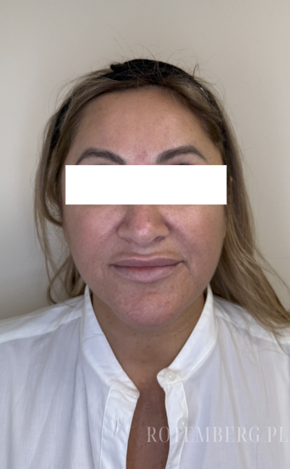 XERF Radiofrequency Skin Tightening Before & After Patient #3862