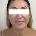 XERF Radiofrequency Skin Tightening Before & After Patient #3862