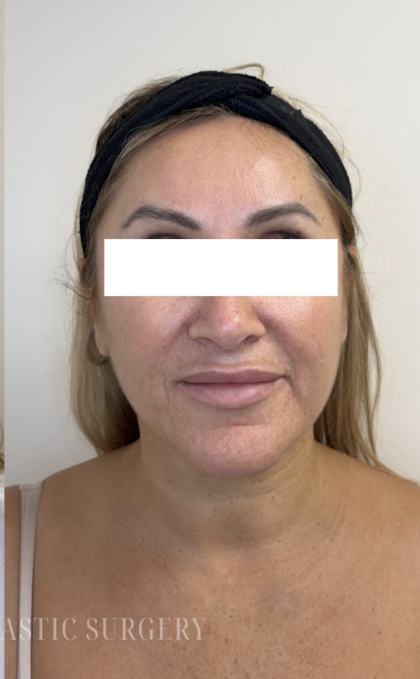 XERF Radiofrequency Skin Tightening Before & After Patient #3862