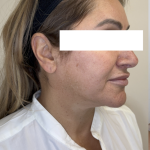 XERF Radiofrequency Skin Tightening Before & After Patient #3862