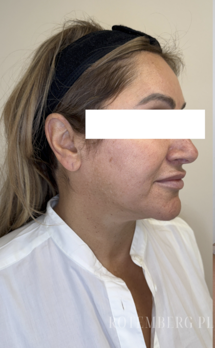 XERF Radiofrequency Skin Tightening Before & After Patient #3862