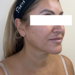 XERF Radiofrequency Skin Tightening Before & After Patient #3862