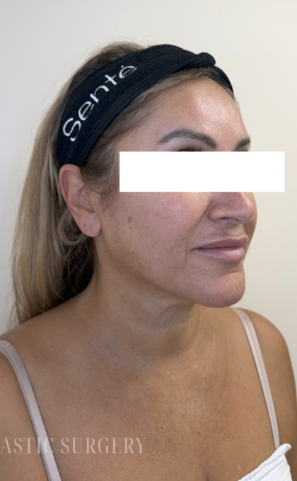XERF Radiofrequency Skin Tightening Before & After Patient #3862