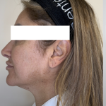 XERF Radiofrequency Skin Tightening Before & After Patient #3862