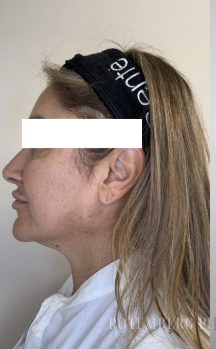 XERF Radiofrequency Skin Tightening Before & After Patient #3862