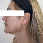 XERF Radiofrequency Skin Tightening Before & After Patient #3862