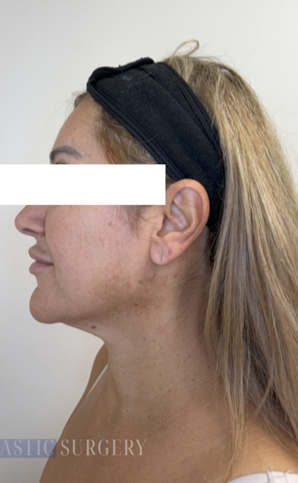 XERF Radiofrequency Skin Tightening Before & After Patient #3862