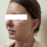 XERF Radiofrequency Skin Tightening Before & After Patient #3863