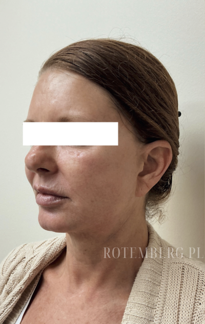 XERF Radiofrequency Skin Tightening Before & After Patient #3863