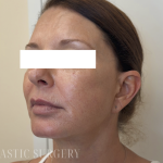 XERF Radiofrequency Skin Tightening Before & After Patient #3863