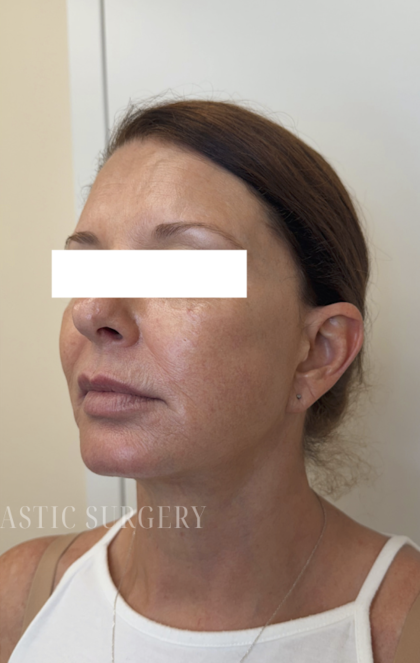 XERF Radiofrequency Skin Tightening Before & After Patient #3863