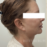 XERF Radiofrequency Skin Tightening Before & After Patient #3863