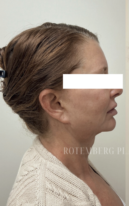 XERF Radiofrequency Skin Tightening Before & After Patient #3863