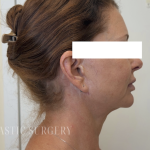 XERF Radiofrequency Skin Tightening Before & After Patient #3863