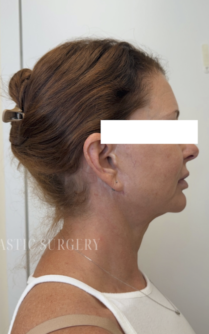 XERF Radiofrequency Skin Tightening Before & After Patient #3863