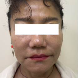 XERF Radiofrequency Skin Tightening Before & After Patient #3864
