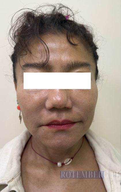 XERF Radiofrequency Skin Tightening Before & After Patient #3864