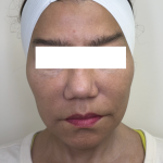 XERF Radiofrequency Skin Tightening Before & After Patient #3864