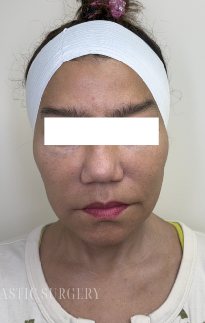 XERF Radiofrequency Skin Tightening Before & After Patient #3864