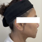 XERF Radiofrequency Skin Tightening Before & After Patient #3864