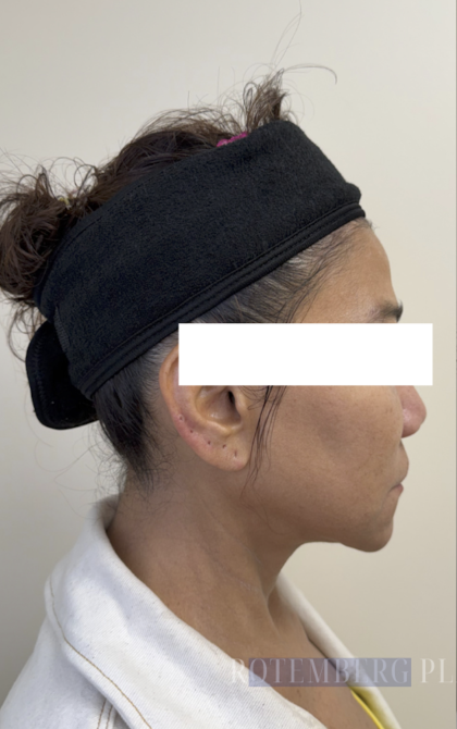 XERF Radiofrequency Skin Tightening Before & After Patient #3864