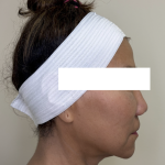 XERF Radiofrequency Skin Tightening Before & After Patient #3864
