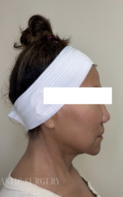 XERF Radiofrequency Skin Tightening Before & After Patient #3864