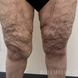 Bilateral Thigh Lift Before & After Patient #3879