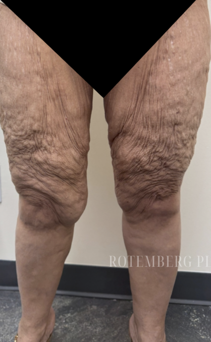 Bilateral Thigh Lift Before & After Patient #3879
