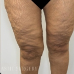 Bilateral Thigh Lift Before & After Patient #3879
