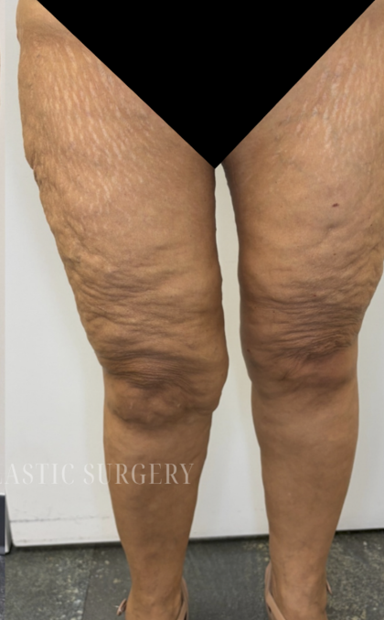 Bilateral Thigh Lift Before & After Patient #3879