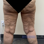 Bilateral Thigh Lift Before & After Patient #3879