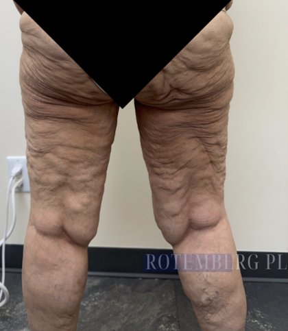 Bilateral Thigh Lift Before & After Patient #3879