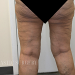 Bilateral Thigh Lift Before & After Patient #3879