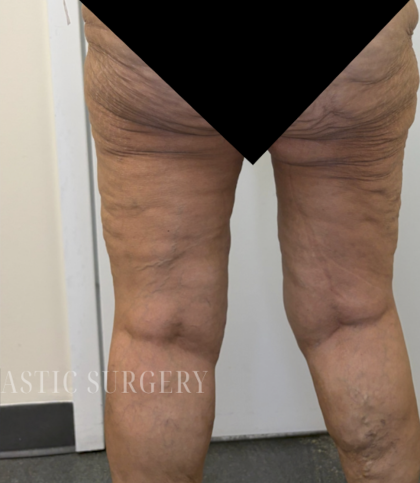Bilateral Thigh Lift Before & After Patient #3879