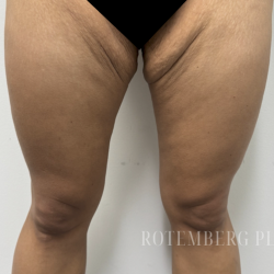 Bilateral Thigh Lift Before & After Patient #3880