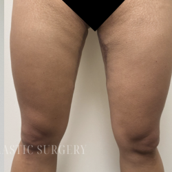 Bilateral Thigh Lift Before & After Patient #3880
